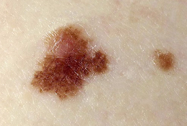 cancerous-skin-tags-skin-cancer-quiz-skin-tag-removal