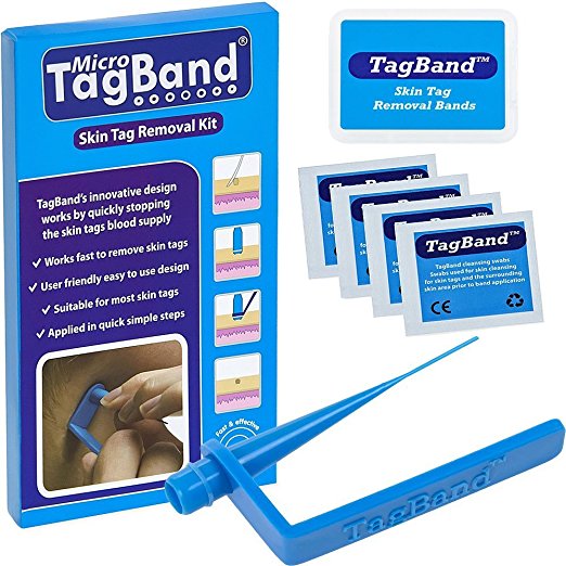 micro tagband skin tag removal
